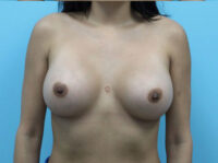 Breast Augmentation