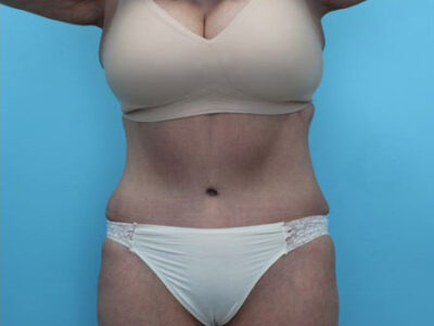 Abdominoplasty