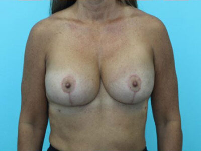 Augmentation & Mastopexy