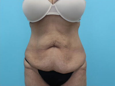 Abdominoplasty