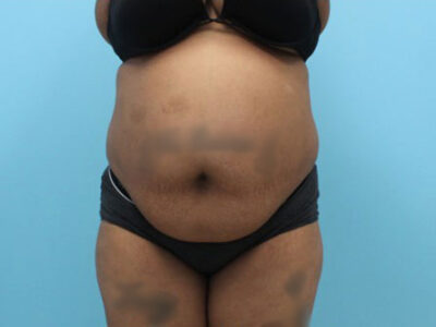 Abdominoplasty