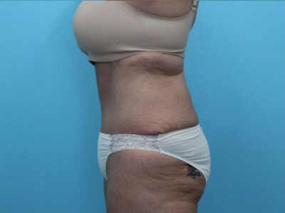 Abdominoplasty