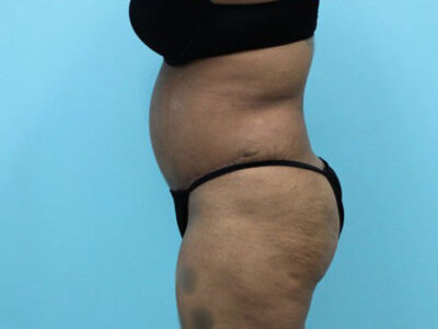 Abdominoplasty