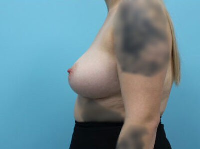 Breast Augmentation