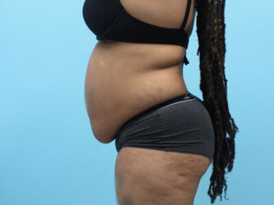 Abdominoplasty
