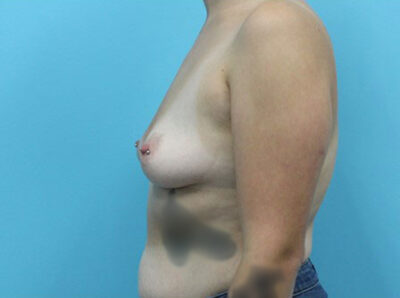Breast Augmentation