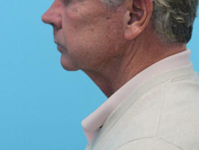 Necklift
