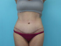 Abdominoplasty