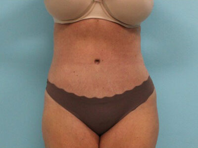 Abdominoplasty