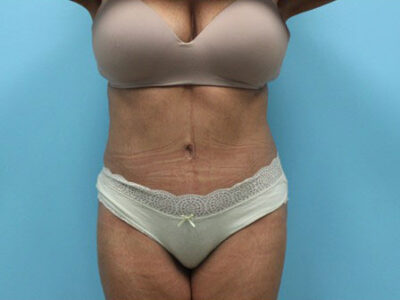 Abdominoplasty