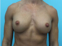 Breast Implant Exchange
