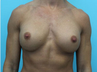 Breast Implant Exchange