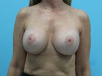Breast Implant Exchange