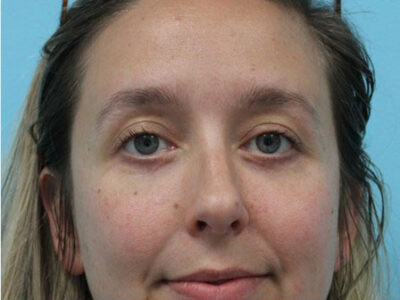 Blepharoplasty