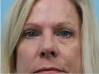 Blepharoplasty