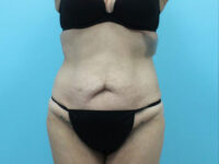 Abdominoplasty