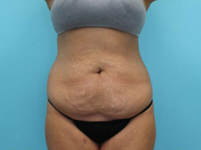 Abdominoplasty