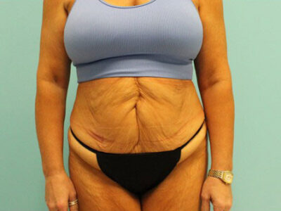 Abdominoplasty