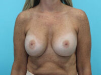 Breast Implant Exchange