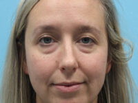 Blepharoplasty