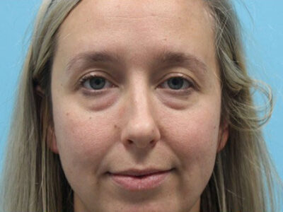 Blepharoplasty