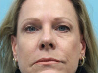 Blepharoplasty