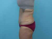 Abdominoplasty