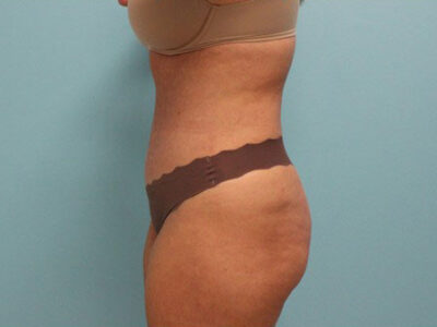 Abdominoplasty
