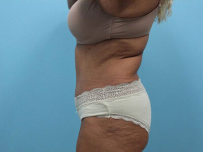 Abdominoplasty