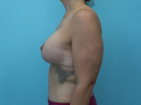 Augmentation & Mastopexy