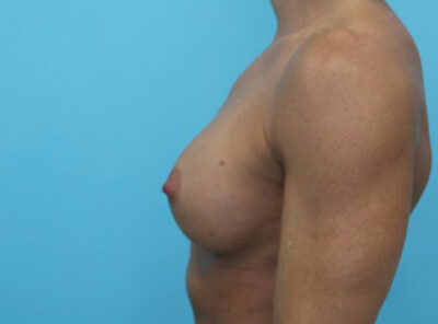 Breast Implant Exchange