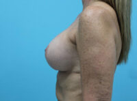 Breast Implant Exchange