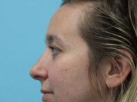Blepharoplasty