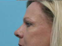 Blepharoplasty