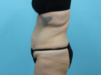 Abdominoplasty