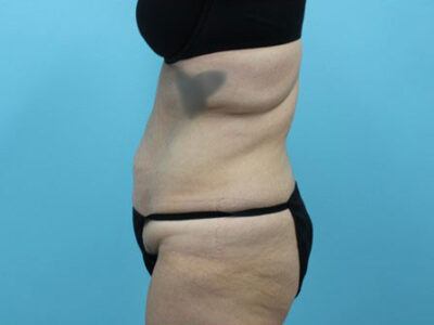 Abdominoplasty