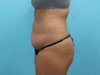 Abdominoplasty