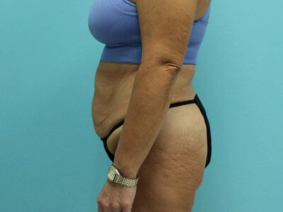 Abdominoplasty