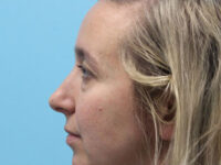 Blepharoplasty