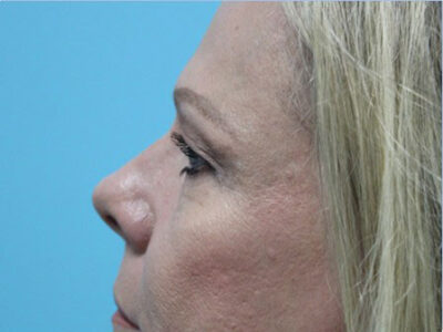 Blepharoplasty