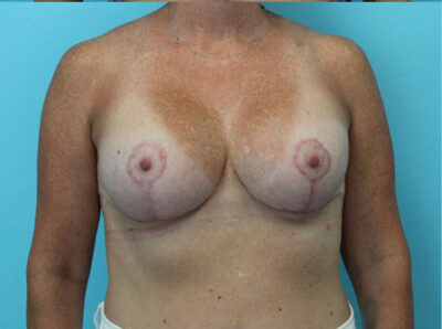 Augmentation & Mastopexy