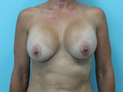Augmentation & Mastopexy