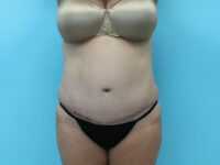 Abdominoplasty
