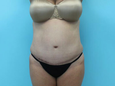 Abdominoplasty