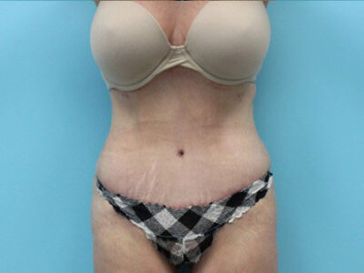 Abdominoplasty