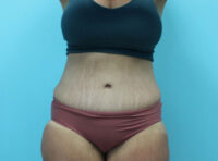 Abdominoplasty