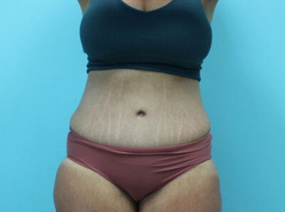 Abdominoplasty