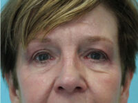 Blepharoplasty