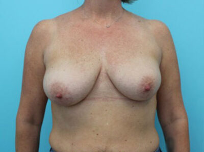 Augmentation & Mastopexy
