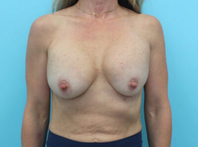 Augmentation & Mastopexy